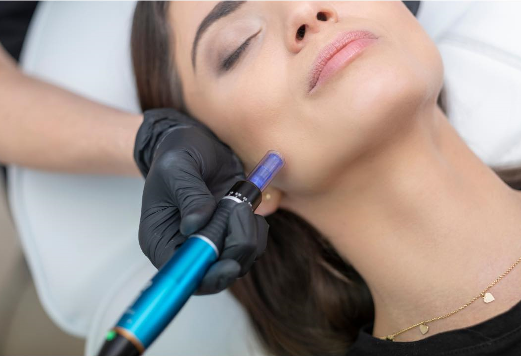 micro-needling