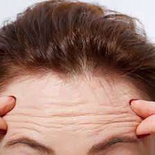 Why do Forehead Wrinkles appear? Forehead wrinkles are caused by the action of the frontalis muscle on the forehead