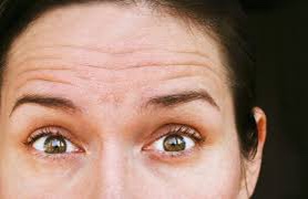 It is commonly used to rejuvenate the appearance of the crow's feet, forehead lines, and glabella frown lines between the eyes.anti-wrinkle