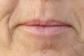 Anti-wrinkle injections are an excellent treatment option for revitalising and smoothing the appearance of frown lines, forehead lines, bunny lines, crow's feet, and other wrinkles.