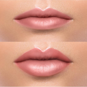Hobart lip filler before and after Cupid’s Bow