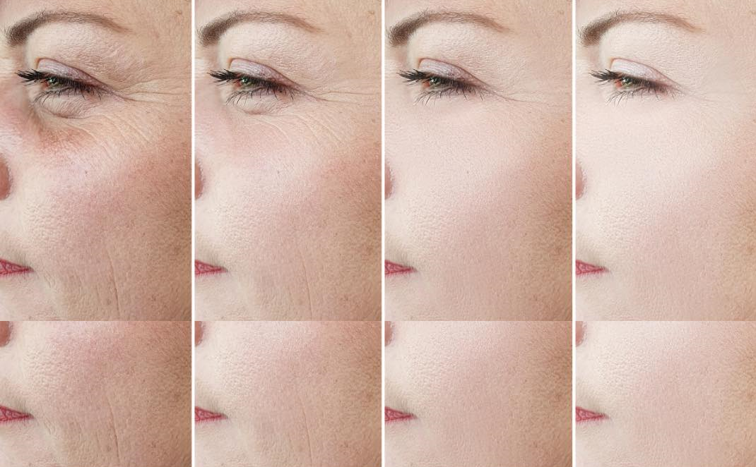 Common anti-wrinkle treatment areas include: forehead lines, brow lift, frown lines, crow’s feet, bunny lines, and masseters