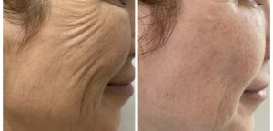 Our Hobart dermal fillers to soften deep lines and restore facial contours