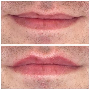 Lip Injections | Dermal Filler | Eden Cosmetics Hobart Anti-wrinkle injections