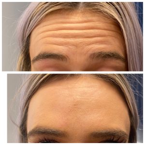 Remove forehead lines with Anti-wrinkle treatments in Hobart | Eden Cosmetic Therapies