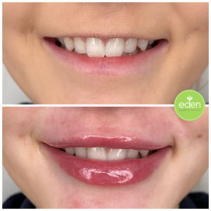 Benefit from the extensive support offered throughout your gummy smile treatment journey at Eden Cosmetic Therapies.