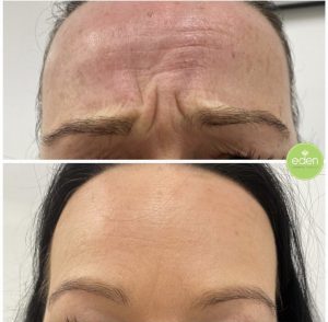 Anti-wrinkle injections are a highly effective method of preventing the appearance of early aging, rather than trying to fix damage to the skin after it has already occurred