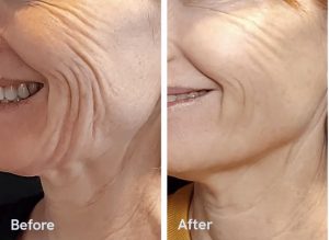 Dermal fillers restore lost volume from aging 