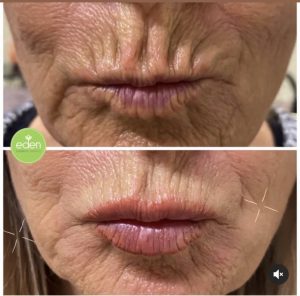 Beautiful, youthful skin on display after a successful anti-aging treatment at Hobart's premier clinic, Eden Cosmetic Therapies