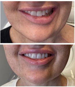 Fixing Facial Asymmetry anti-wrinkle Hobart