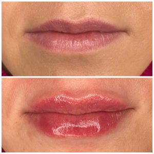 Both lip fillers and lip flips can be combined for enhanced results. This popular method could involve a dermal filler for the lower lip and a lip flip for the upper, or adding a lip flip to existing fillers to boost the shape and prolong effects.