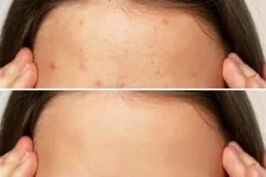 Choose Eden Cosmetics in Hobart for advanced skin needling therapies that minimize acne scars, boost collagen production, and reveal healthier skin.