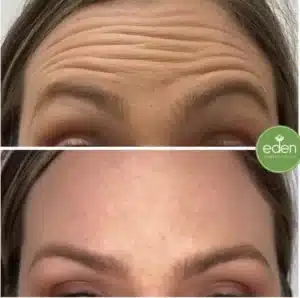 Forehead line anti-wrinkle treatment - Hobart