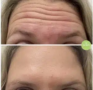 Forehead Lines Anti Wrinkle Treatment