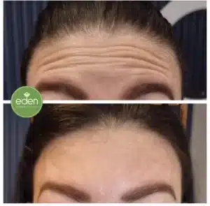 Anti-Wrinkle Injections for Forehead & Frown Lines