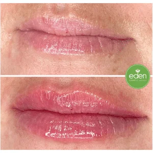 Boost your lip confidence in Hobart with fillers