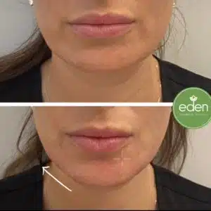 Chin filler helps create a strong chin