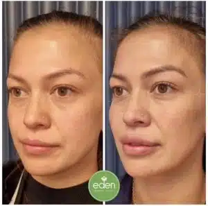 Chin filler helps create a strong chin