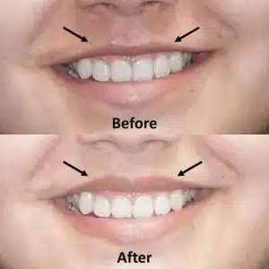 Using Anti wrinkle injections in a lip flip treatment