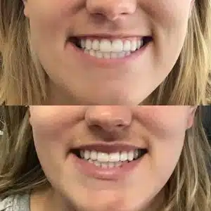 Lip Flip Or Lip Filler – Which Option Produces Better